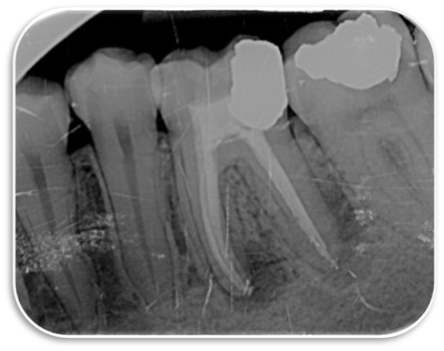 Root canal treatment