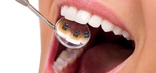 Lingual braces